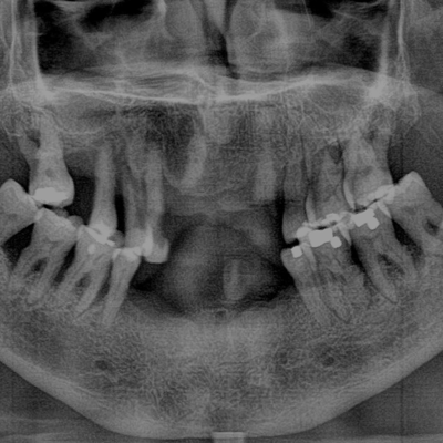 Dental X-Ray Photo